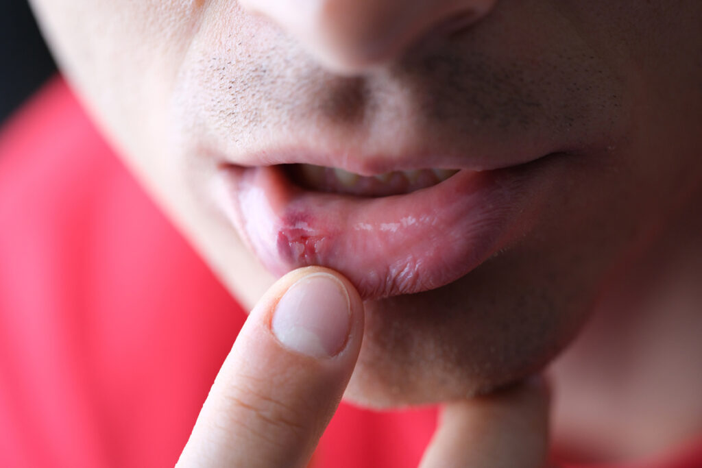 cold sores remedy